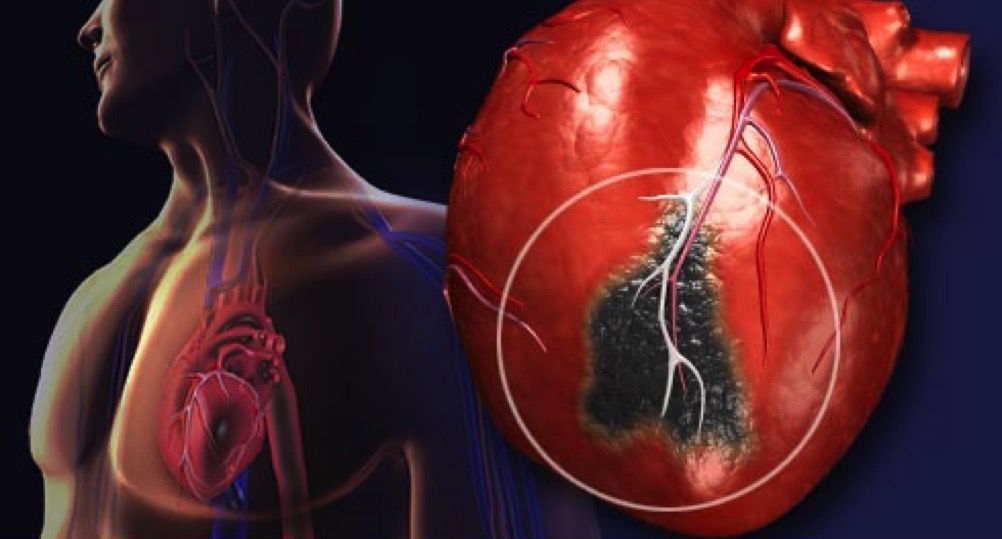 Причины инфаркта миокарда